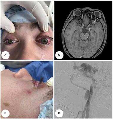 A case report of multi-step management of extracranial carotid artery aneurysm and carotid-cavernous fistula combination in patients